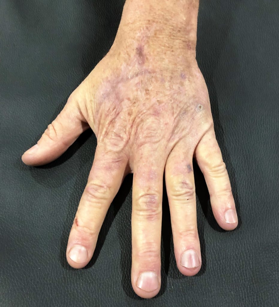 Patient's hand after 1-2 months of Certified Hand Therapy with Kris Siegenthaler. Patient's hand is completely healed and usable.
