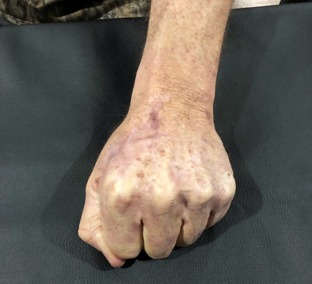 Patient's hand after Certified Hand Therapy with Kris. Patient is making a fist, demonstrating he's gained back full range of motion. 