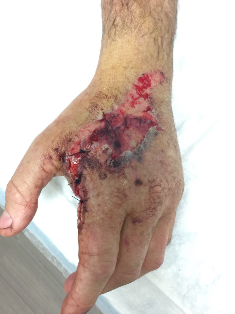 Patient's injured hand after surgery. The surgeon repaired the patient's hand and ordered Certified Hand Therapy.