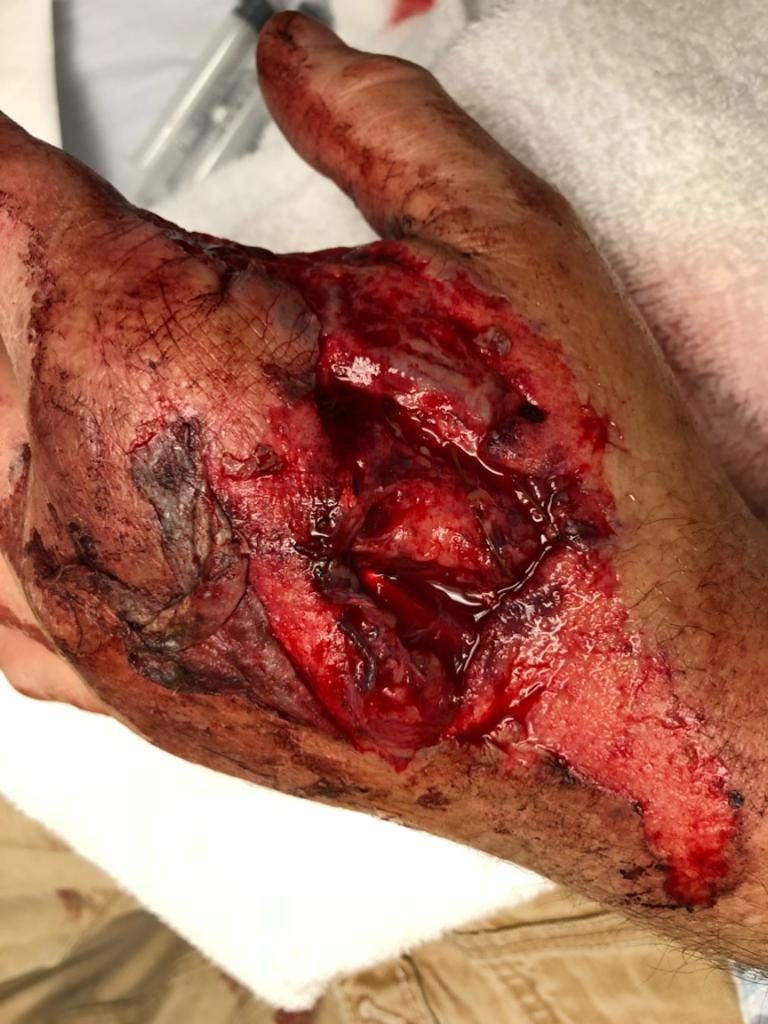Severely injured hand. Patient was involved in an ATV accident that resulted in a deep laceration. After surgery, the patient required therapy provided by a Certified Hand Therapist.