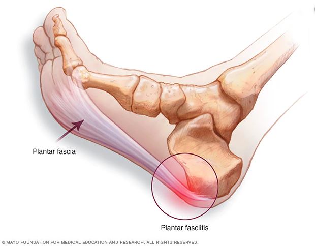 A picture showing the location of the plantar fascia and the area where plantar fasciitis occurs near the heel.